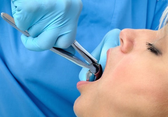 What to do after tooth extraction
