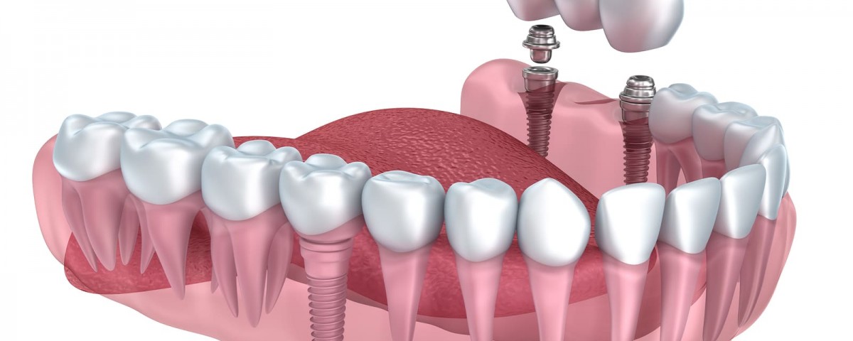 Cosmetic Dental Implant