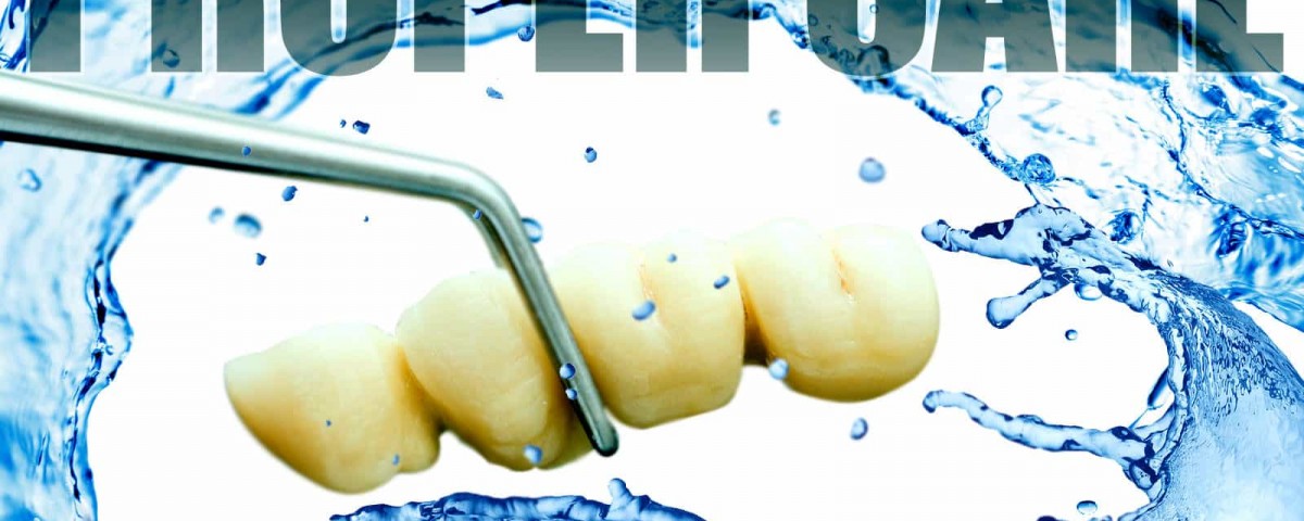 Tips for Cleaning Dental Bridge