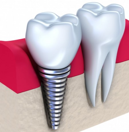Dental Implant Failure Solution