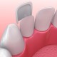 What To Do If You Have Veneer Troubles