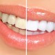 Sensitivity after teeth whitening