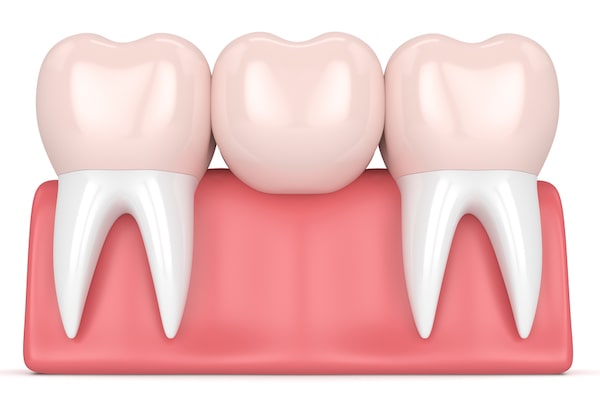 What are dental bridges
