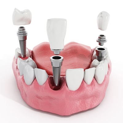 How is dental implants placed
